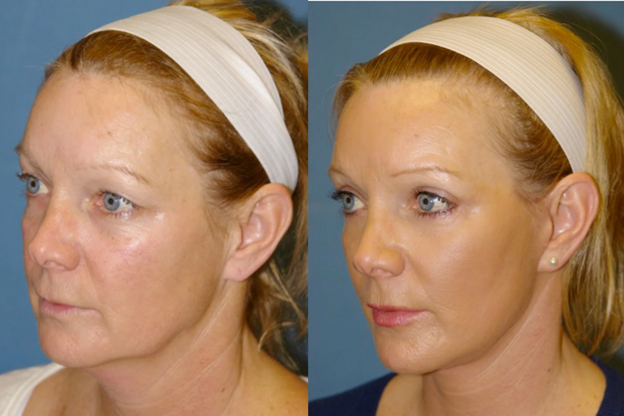Blepharoplasty