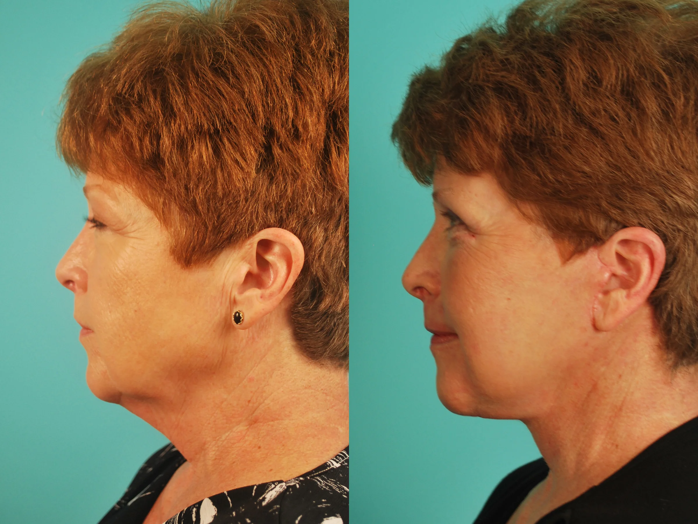 Facelift & Blepharoplasty