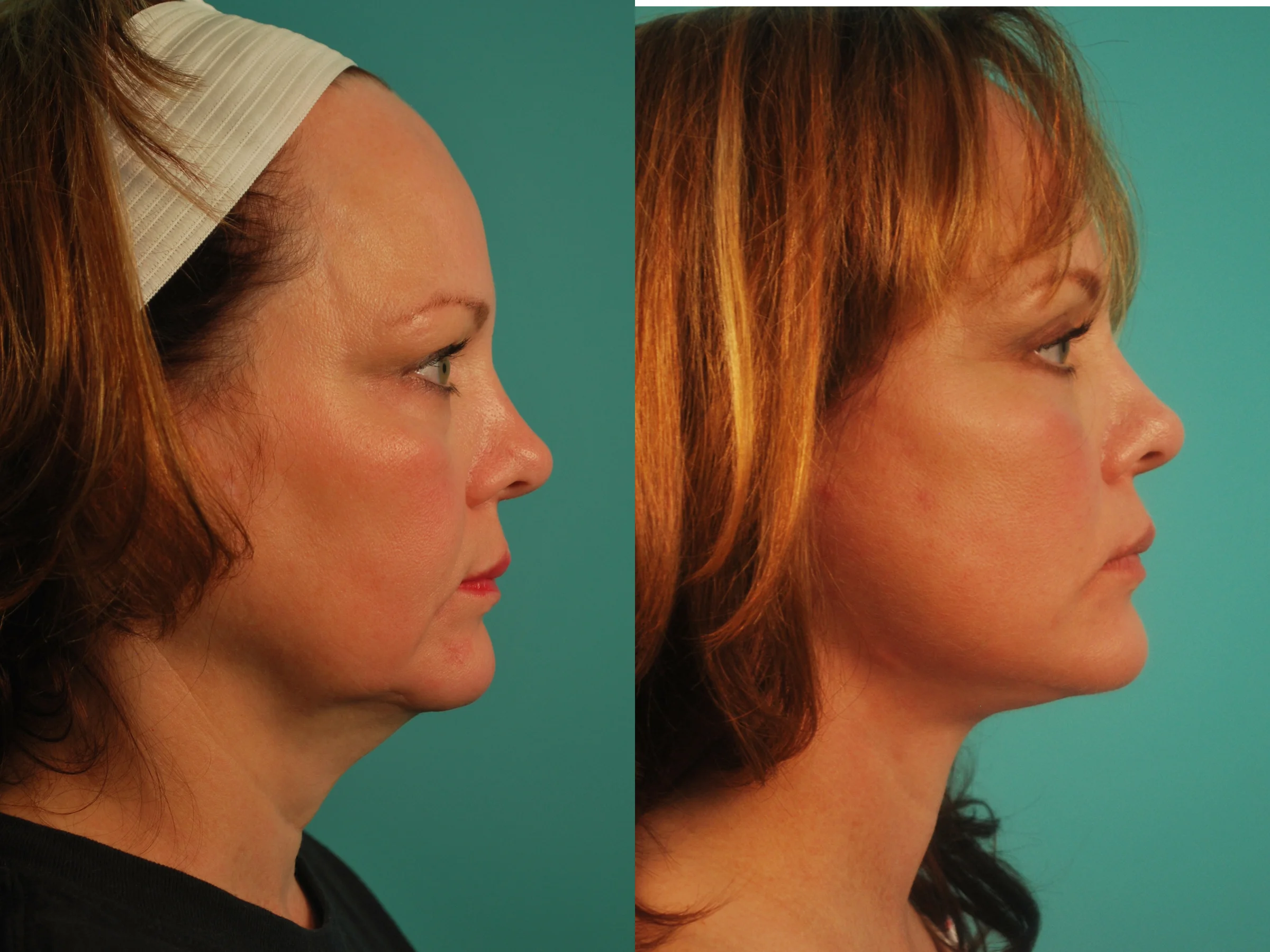 Mini Facelift & Upper Blepharoplasty