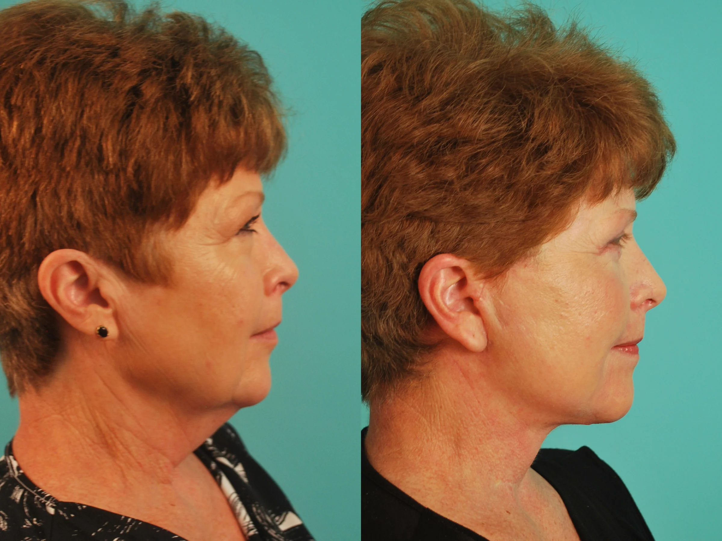 Facelift & Blepharoplasty