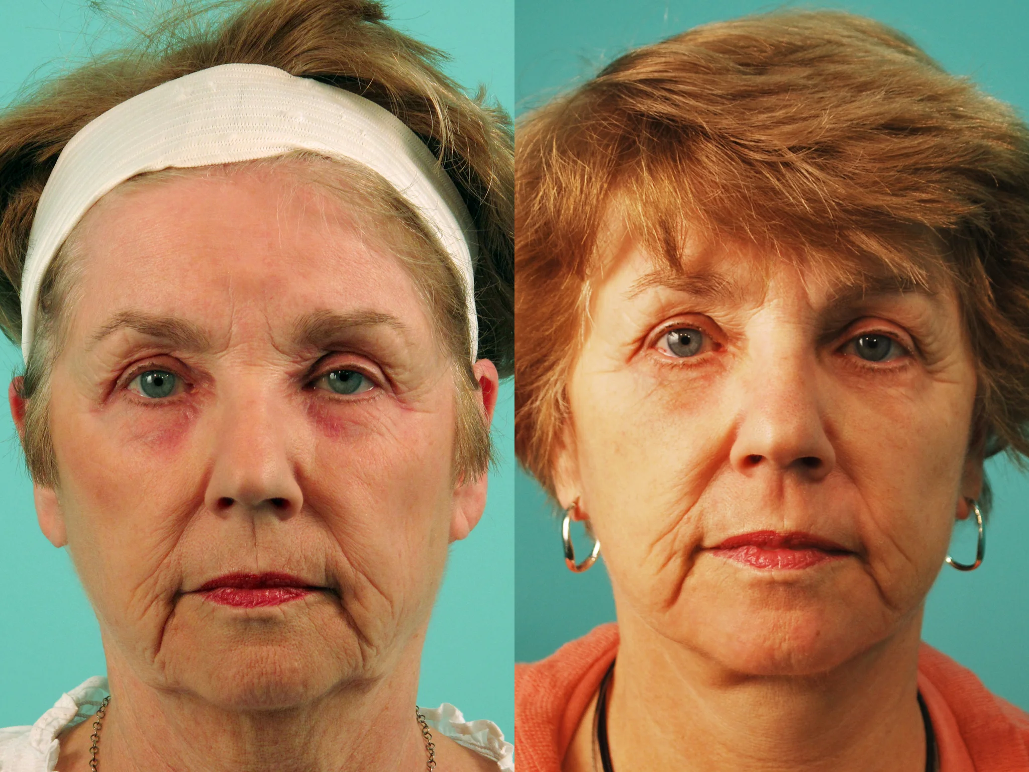 Facelift