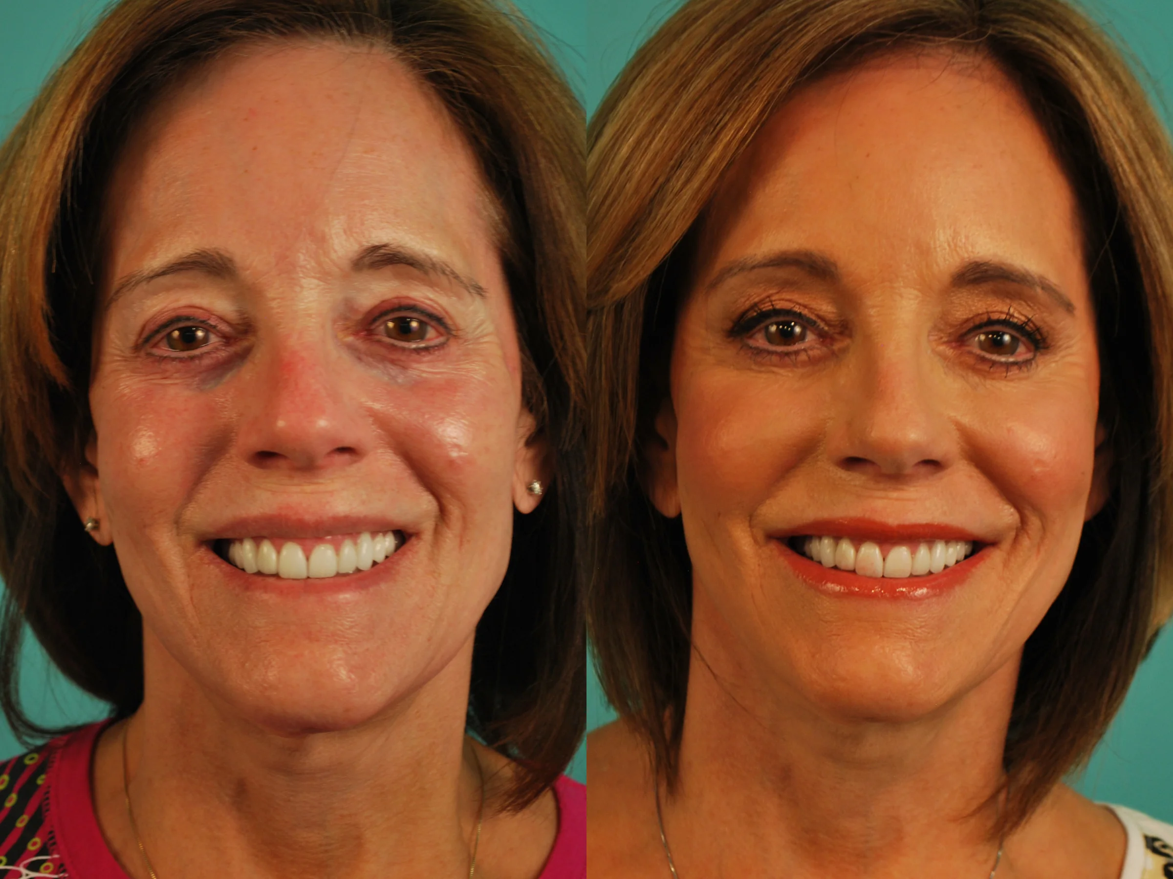 Voluma in Cheeks