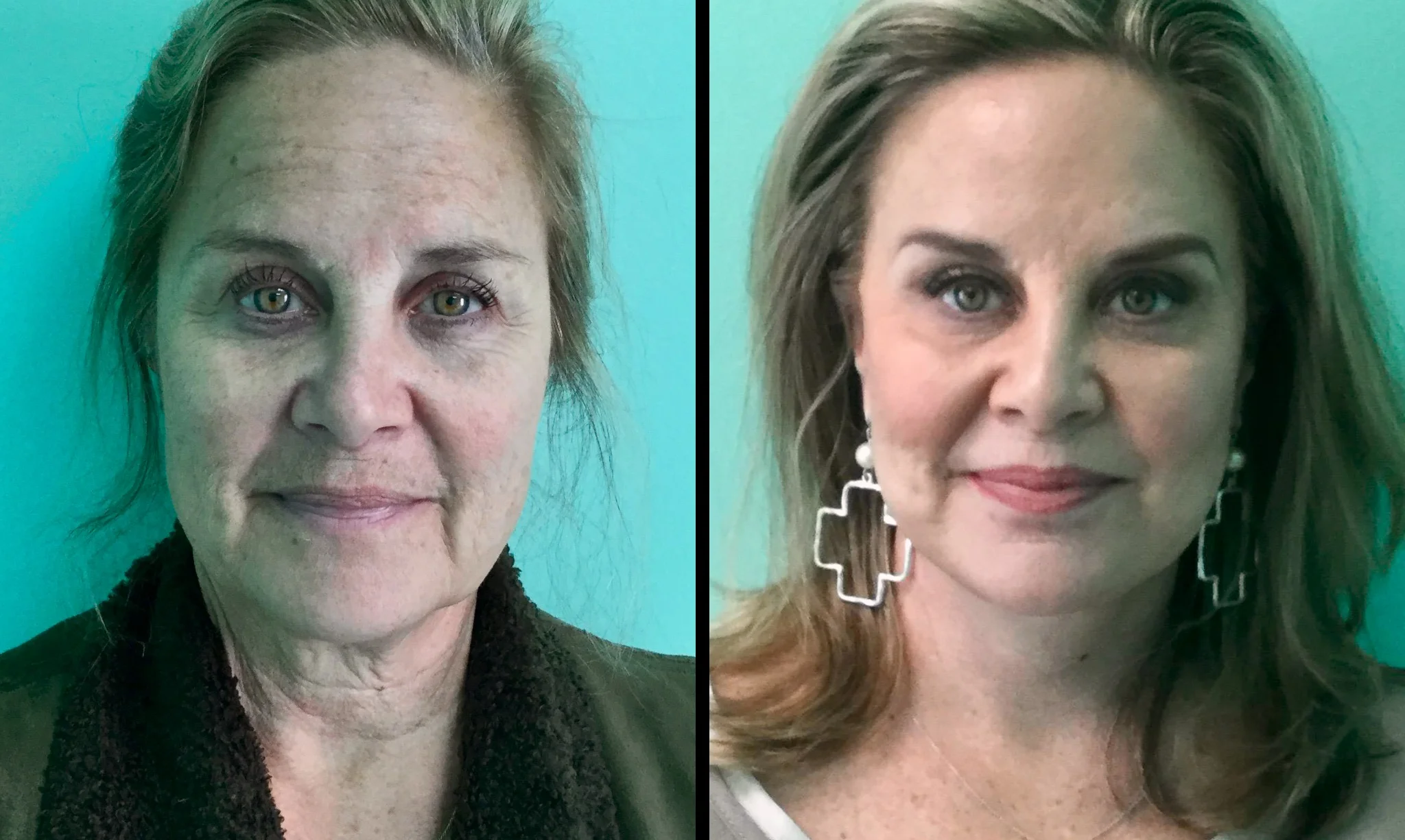 Facelift