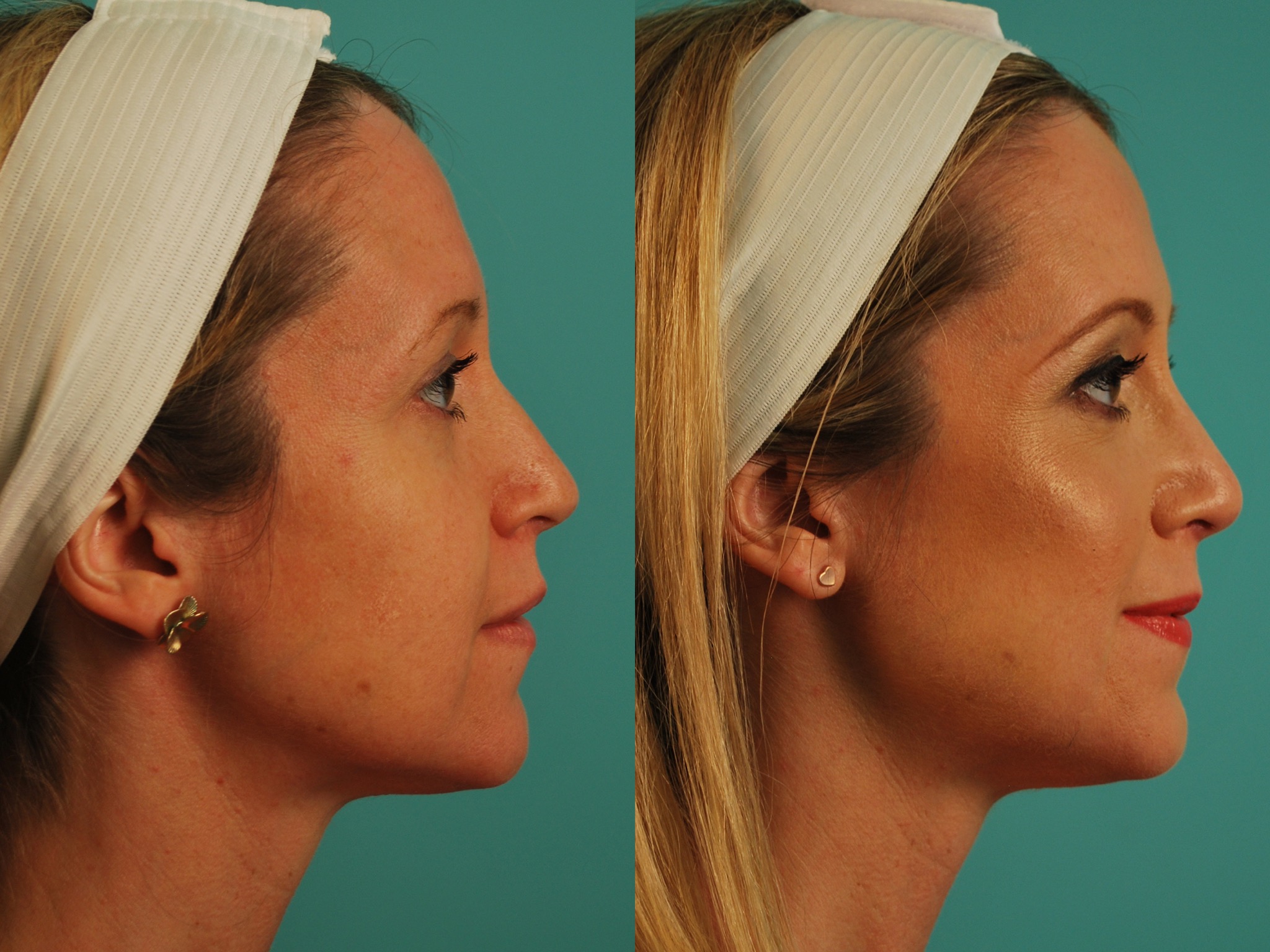 Filler - Voluma in Cheeks