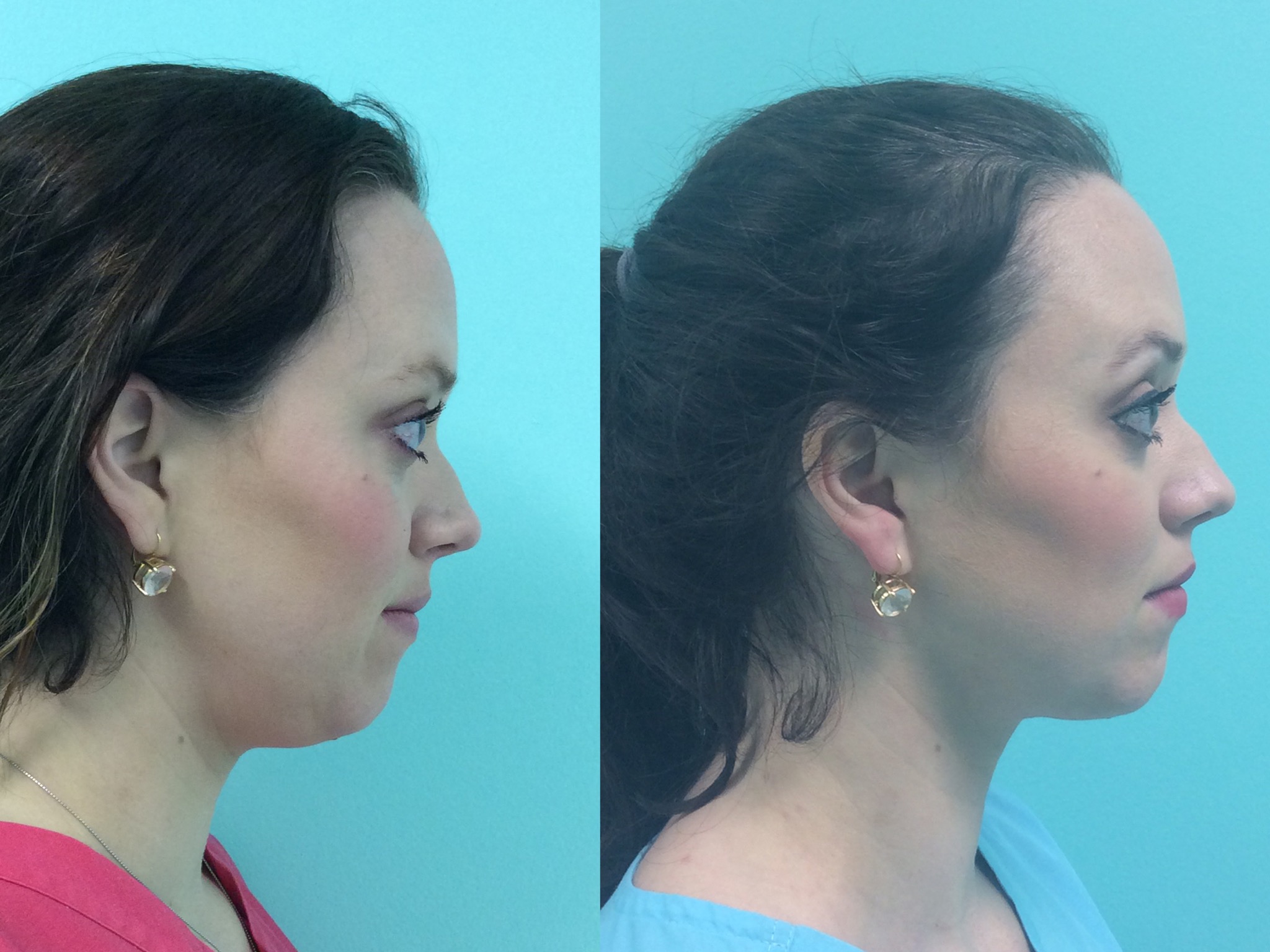 Kybella for 'Double Chin'