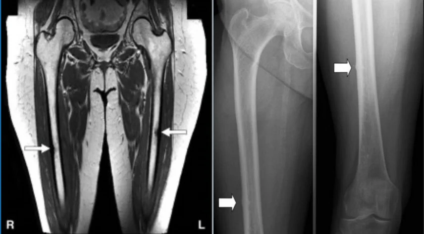 FEMORAL SHAFT STRESS FRACTURE