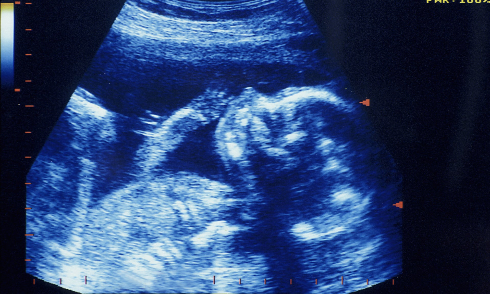 Кружится голова у беременной. Синдром Дауна на УЗИ 20 недель. УЗИ на 13 неделе беременности синдром Дауна. Снимки УЗИ С синдромом Дауна. УЗИ плода с синдромом Дауна в 20 недель.