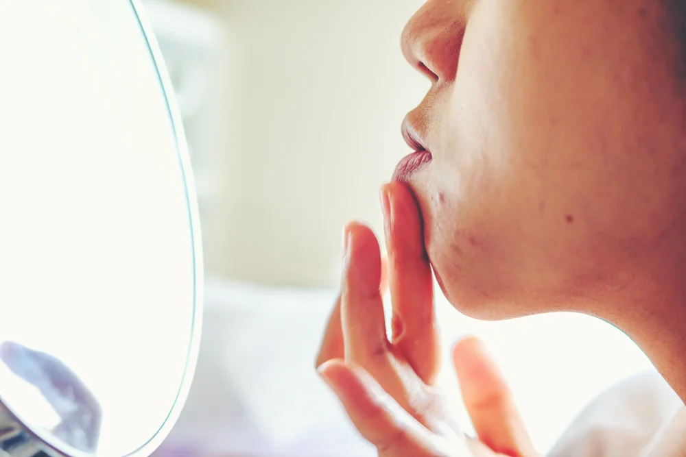 Still Got Acne Problems? Try This Little Tube of Miracle