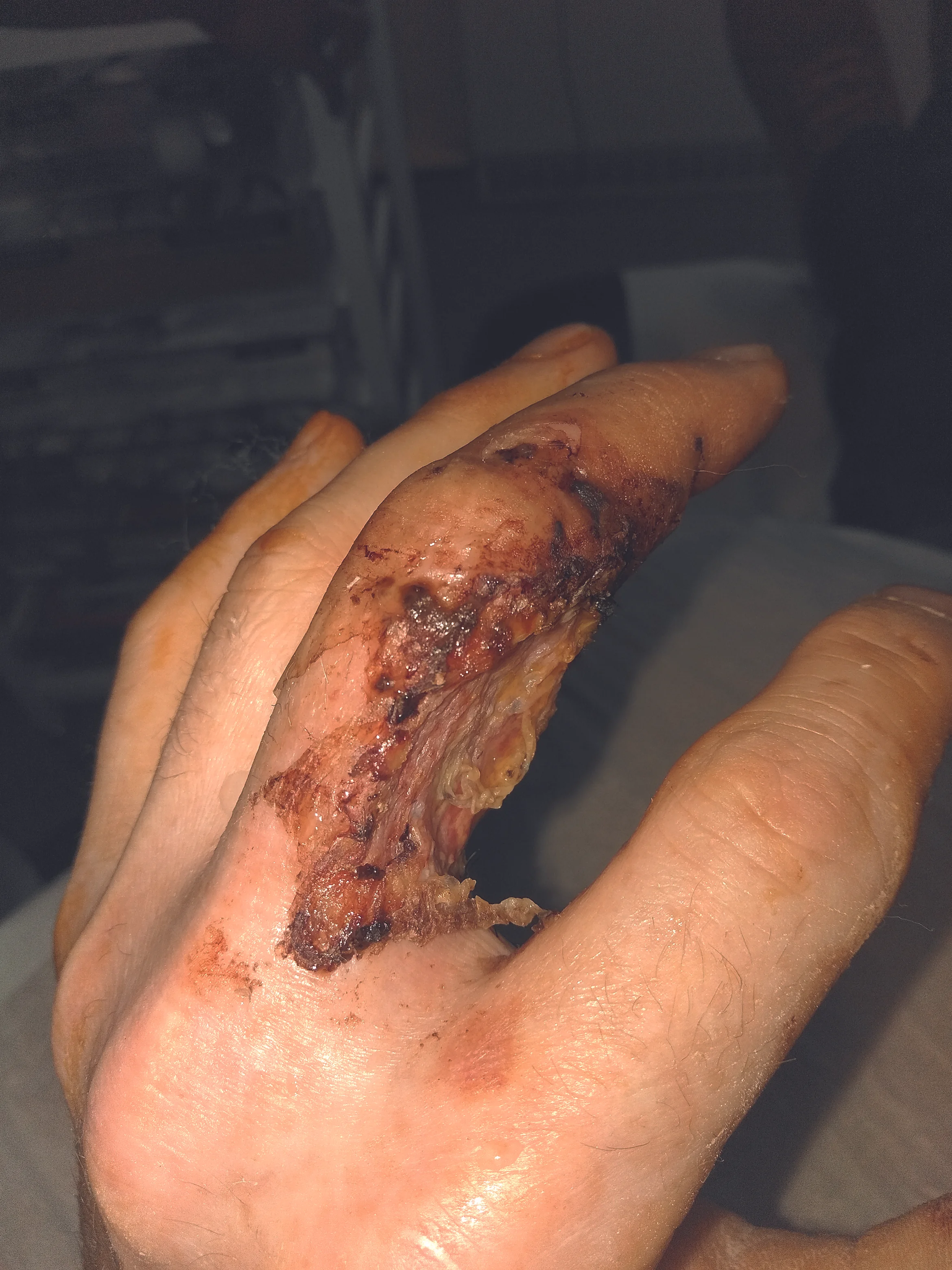 Septicaemia - Image 1.jpg