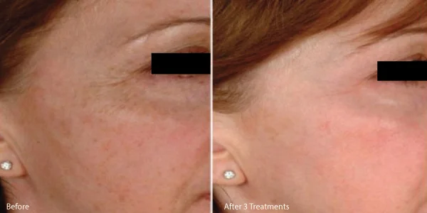 microneedle-los-angeles-before-and-after.jpg