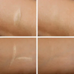 scar-revision-22-300x300.jpg