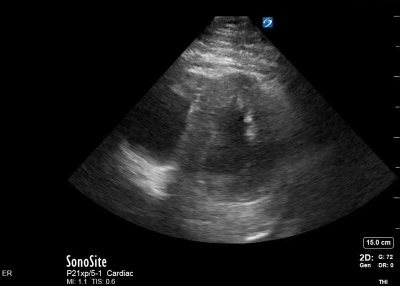 This is a parasternal short axis view in a patient with extensive pulmonary emboli on CTA. The troponin was mildly elevated and patient hemodynamically stable. A bedside echo revealed evidence of RV strain (note the “D” shaped left ventricle). Image courtesy of: Therese Mead, DO, Emergency Physician