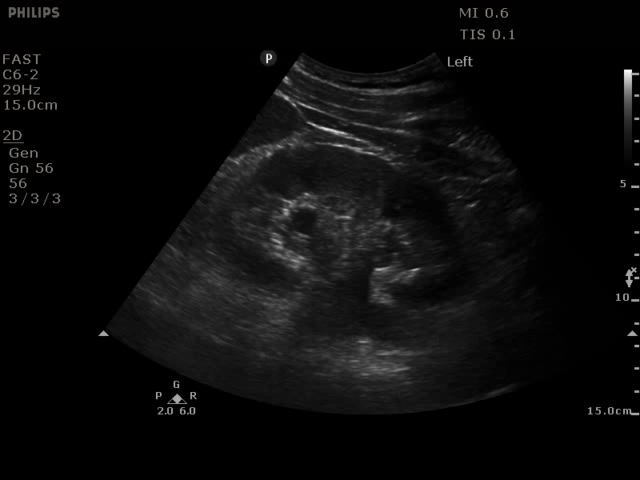Mild To Moderate Left Hydronephrosis
