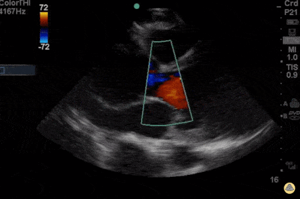 Breaking the rule of 3rds - Aortic Dissection