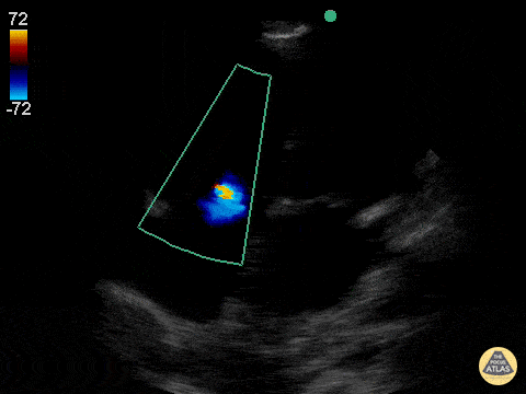 Mild Tricuspid Regurgitation