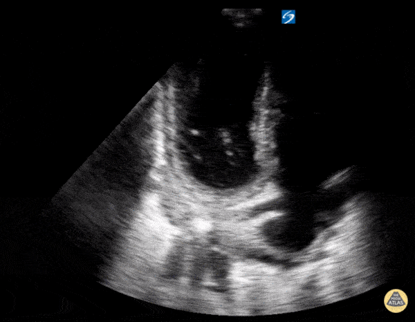 Left Ventricular Dysfunction — TPA