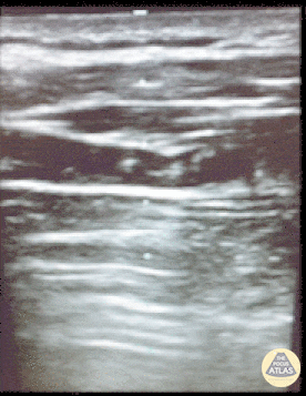 Resolving Pneumothorax