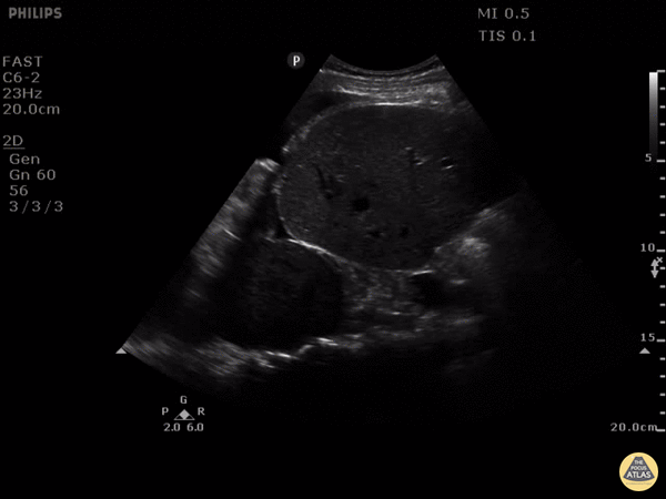 Pleural Effusion, Mass
