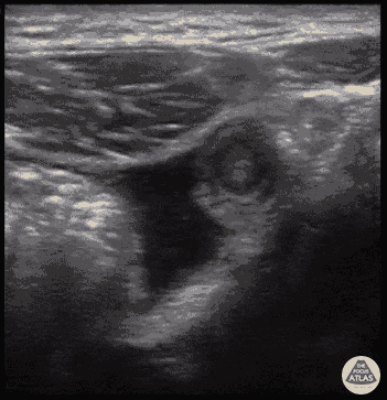 Appendicitis + Free Fluid