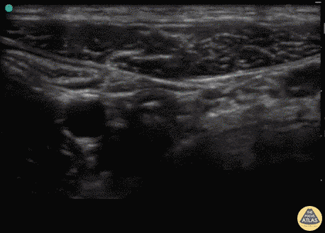Normal Appendix (Transverse)