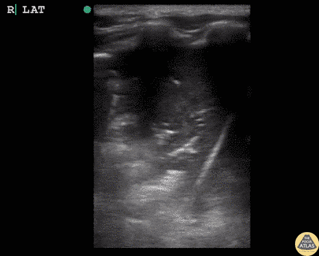 Lung Hepatization (Pneumonia)