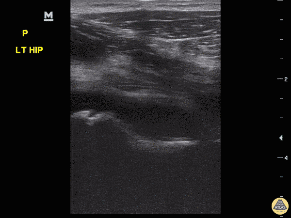 Hip Effusion