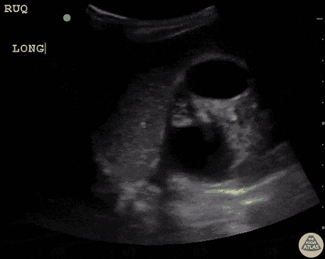 Severe Hydronephrosis in Prune Belly Syndrome