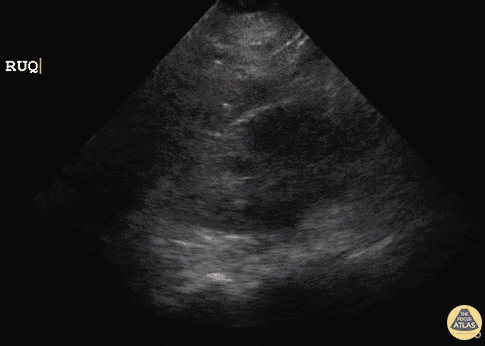 Mild Hydronephrosis