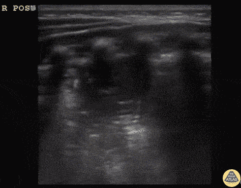 Infant Pneumonia with C-Lines