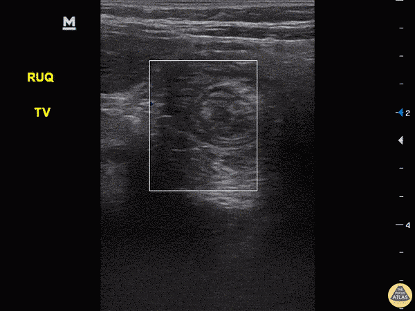 Intussusception with Target Sign