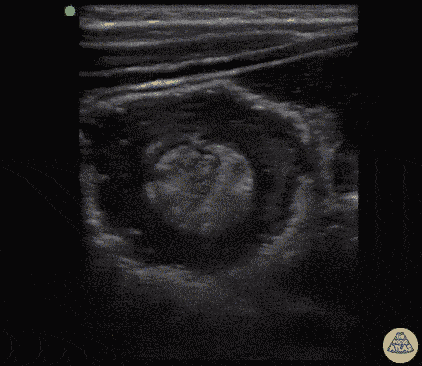 Intussusception with Target Sign