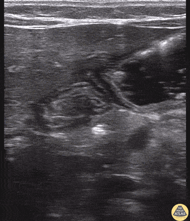 Pylorus (Normal)