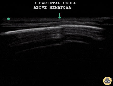 Infant Skull Fracture