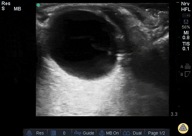 Vitreous vs. Retinal Detachment
