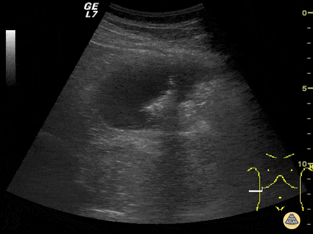 Biliary Colic That Wasn't