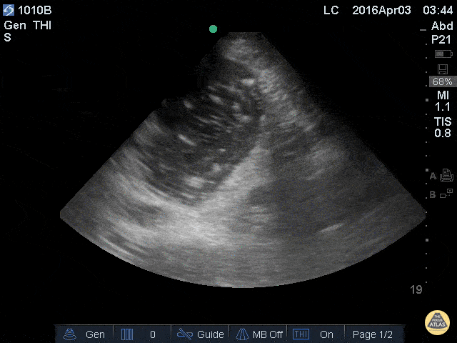 Reducing Aspiration Risk