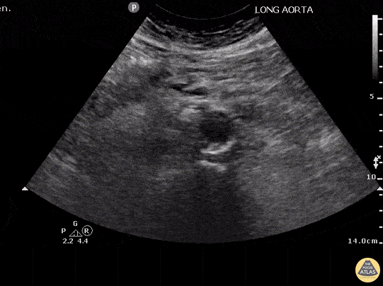 Abdominal Aortic Dissection (Transverse)