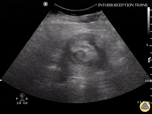 Intussusception Adult