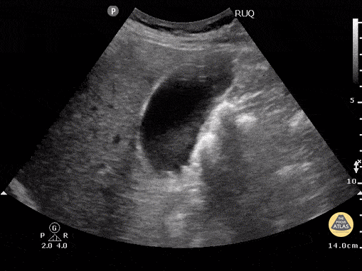 Cholelithiasis - Neck Stones
