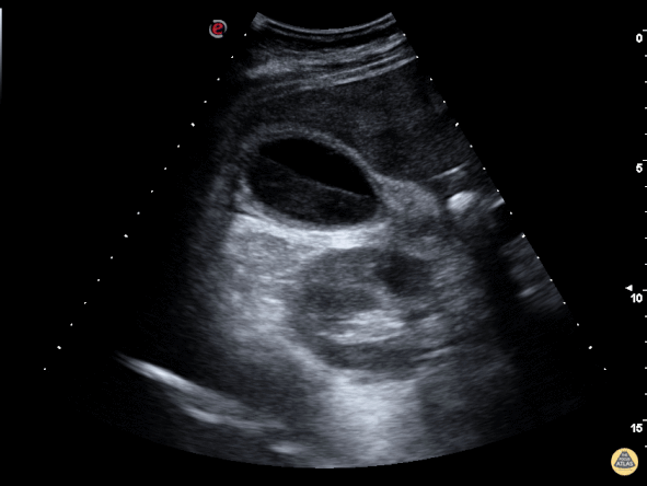 Gallbladder with Biliary Sludge