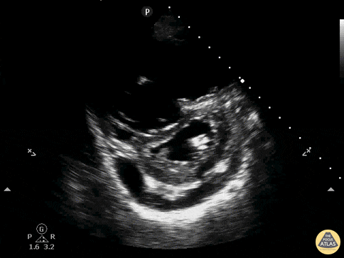 D-Sign with RV Dilation, Effusion, PSSA