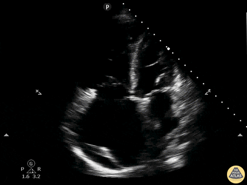RV Dilation, Effusion, A4C