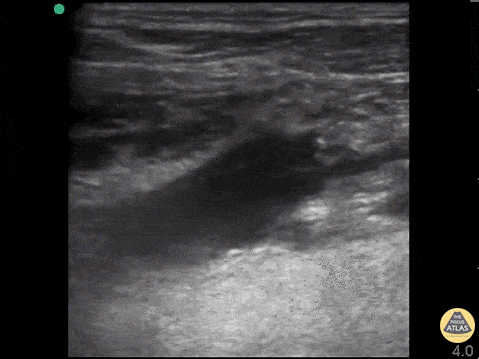 Lemierre Syndrome