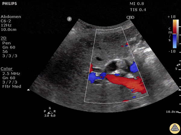 Choledocholithiasis - Dilated Common Bile Duct with Stone