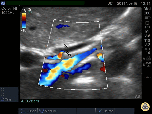 Common Bile Duct (Normal)