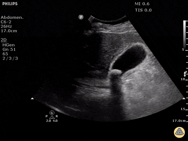 Cholecystitis with Obstructing Stone