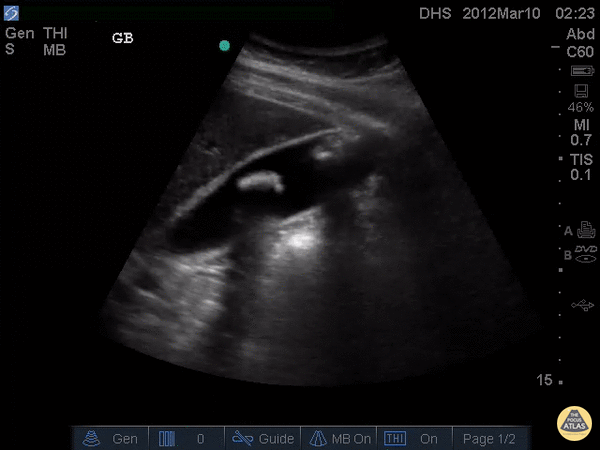 Cholelithiasis, Not Impacted