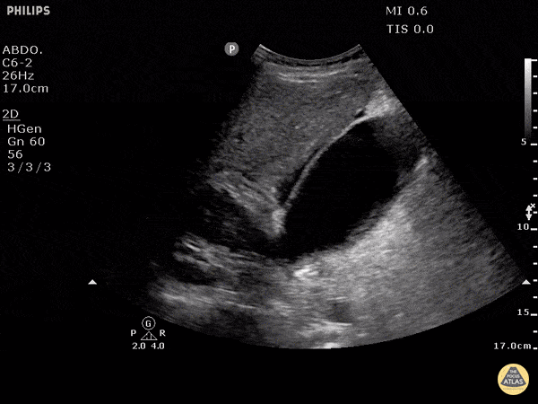 Pericholecystic Fluid