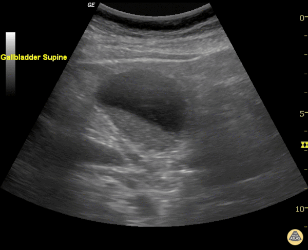 Gallbladder Sludge