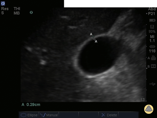 Gallbladder Wall Measurement